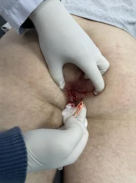 Drainage of perianal abscess Stock Photos