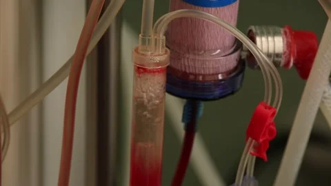 To draw blood through a catheter 3 Video stock 317084049
