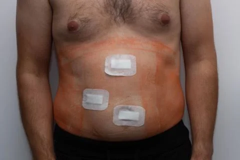 Dressing the wound after laparoscopic surgeryy Stock Photos