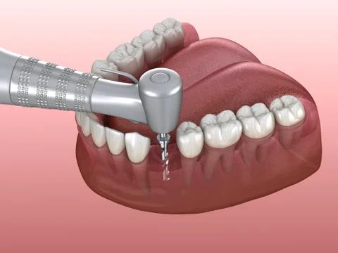Drilling of bone while dental implant placement. Medically accurate 3D illust Stock Illustration