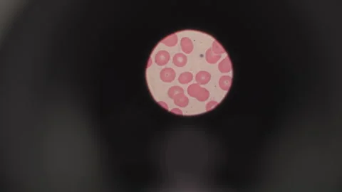 Drop of blood under microscope, vaccine research, medical exam. Microscope view Stock Footage 148580189
