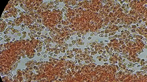 Drop of my blood under microscope Stock Footage