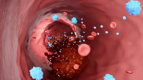 Drug molecules flow through blood vessels, dissolving clots Stockbeeldmateriaal 345012113