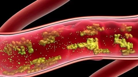 Drugs remove garbage and blood clots from blood vessels 스톡 동영상 344102452