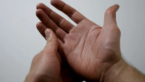 Dry Cracked Hands Stock Footage 83851653