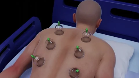 Dry Cupping Therapy. 3D Animation of Dry Cupping Therapy on Back for Pain Relief Stock Footage 315510244