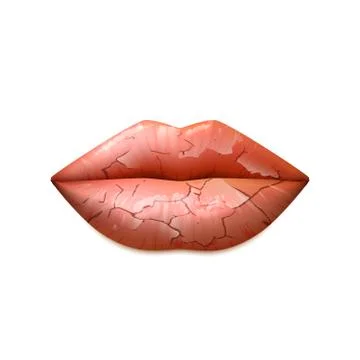 Dry Lips Illustration Stock Illustration