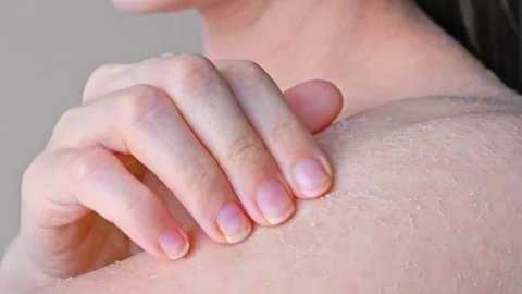 Dry problem skin peeling shoulder close-up side view combing dry skin until Stock Footage 259726189