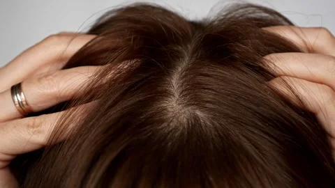 Dry scalp and dandruff problem. Stock Footage 308965091