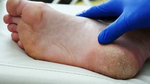 Dry skin, Psoriasis of the foot The Stock Video Pond5