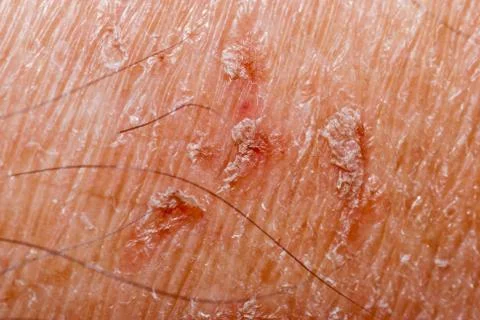 Dry skin texture Stock Photos