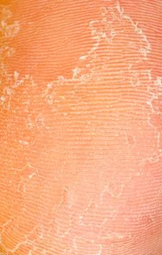 Dry skin texture Stock-Fotos