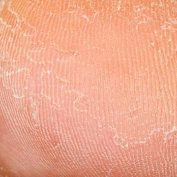 Dry skin texture Stock Photos