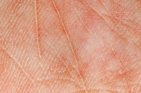 Dry skin texture Stock Photos