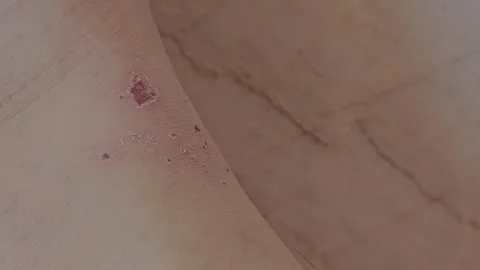 Dry wound caused by itching of the skin Stock Footage 281650409