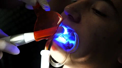 Drying tooth enamel with a portable UV lamp before installing braces Stockbeeldmateriaal 313015043