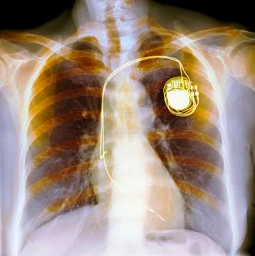 Dual chamber pacemaker, X-ray Stock Photos