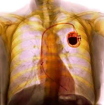 Dual chamber pacemaker, X-ray Stock Photos