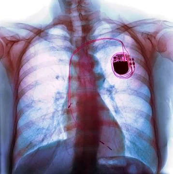 Dual chamber pacemaker, X-ray Stock Photos