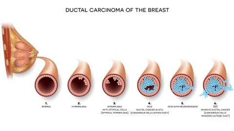 Ductal carcinoma Stock Illustration