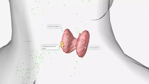 Due to their increased number of cells, enlarged parathyroid glands produce more Stock Footage 231402233