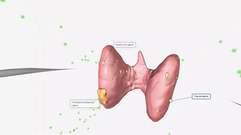 Due to their increased number of cells, enlarged parathyroid glands produce more Stock Footage 231402246