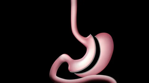 Duodenal switch surgery procedure 스톡 동영상 37929971
