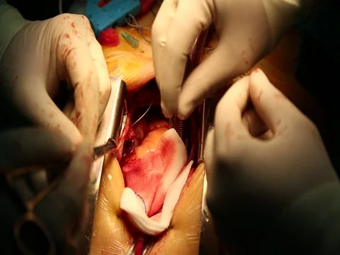 During Open Heart Surgery Stock Footage 78532056