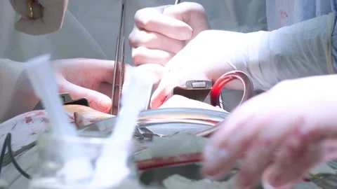 During open heart surgery, if heart valve malfunctions Video stock 237212930