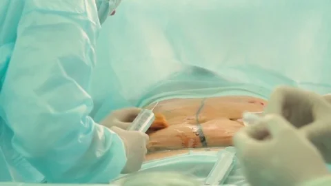 During a plastic surgery to reduce the abdomen, the doctor inserts a huge syring Stock-Footage 70003286