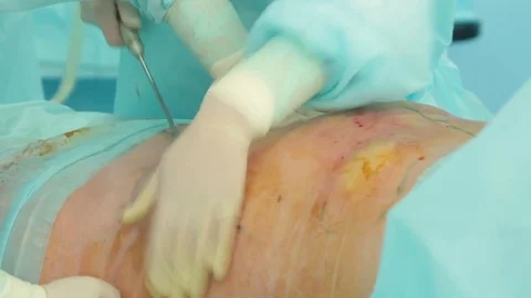 During a plastic surgery to reduce the abdomen, the doctor inserts a huge syring Video stock 70003365