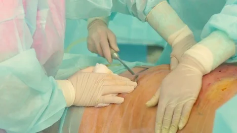 During a plastic surgery to reduce the abdomen, the doctor inserts a huge syring Video stock 70003376