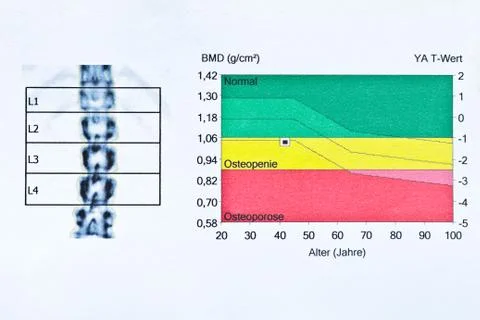 Dxa bone density scan spinal column german Stock Photos