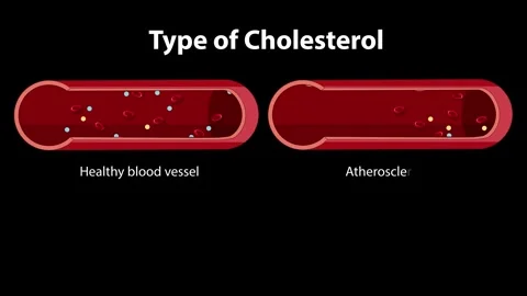 Dynamic animation of cholesterol types in blood vessels, illustrating healt.. Stock Footage 334323283