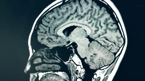 Dynamic image of human brain during CT scanning Stock Footage 147015835