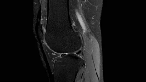 Dynamic scrolling through MRI images of knee joint. Diagnosis sport trauma and Stock Footage 194288536