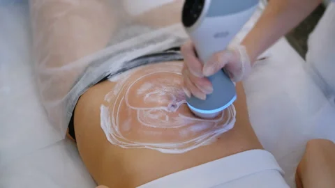 Dynamic Shot of Abdominal Therapy with Advanced Equipment Stockbeeldmateriaal 306272779