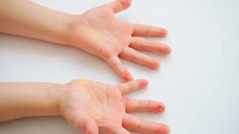 Dyshidrosis. Stock Footage 265968673