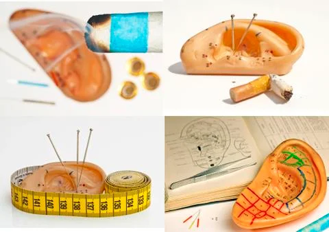 Ear acupuncture Stock Photos