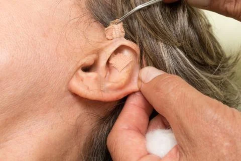 Ear Acupunture Stock Photos