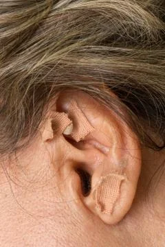 Ear Acupunture Stock Photos