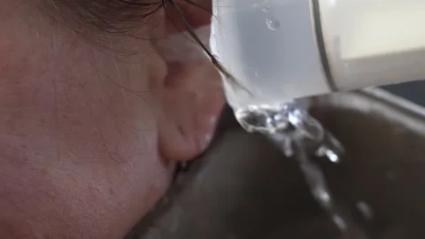 Ear irrigation procedure with water flow from syringe into basin Vídeos de archivo 345053805