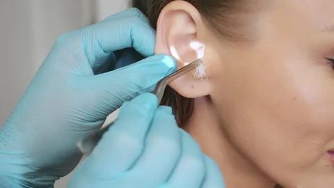 Ear treatment by ENT doctor inserting gauze wick into ear canal. Vídeo Stock 321577013