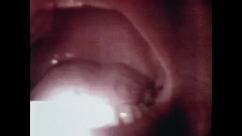EARTH ORBIT - 1973: Upper teeth and lips - Skylab 3 remote medical oral close-up Vidéo 347641604