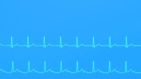 ECG comparison of normal heart rhythm and AV block. イラスト素材