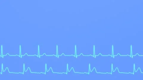 ECG comparison of the normal heart rhythm of a healthy patient and the ECG .. Stock Photos