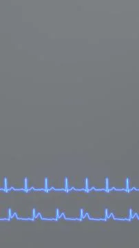 ECG comparison of the normal heart rhythm of a healthy patient and the ECG .. 스톡 사진
