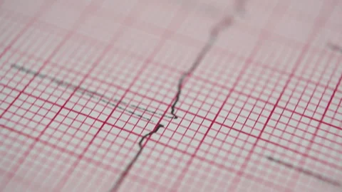 An ECG (electrocardiogram) graph printed on paper. Stock Footage 318837647