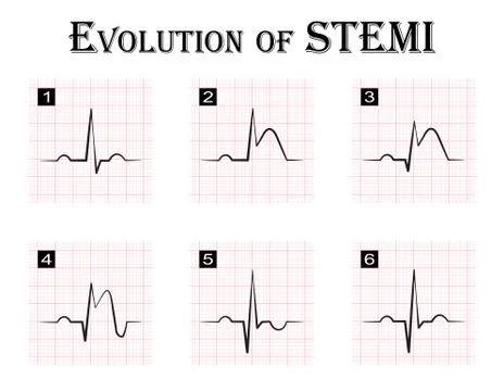 ECG of evolution ( step by step ) of STEMI ( ST elevation myocardial infarcti Stock Illustration