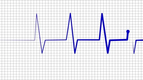 Ecg heart rhythm line on graph paper showing pulse spikes and flat line ani.. Stock Footage 336905083